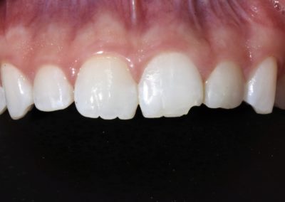 Chipped tooth for composite resin treatment