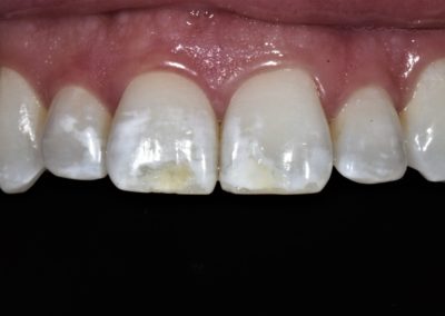 Closeup of a patient's teeth before Icon white spot treatment.