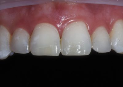 Closeup of a patient's teeth after Icon white spot treatment.