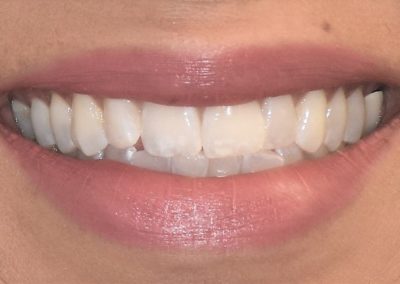 Closeup of a woman's teeth after Invisalign treatment