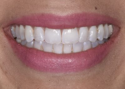Closeup of a woman's teeth after Invisalign treatment