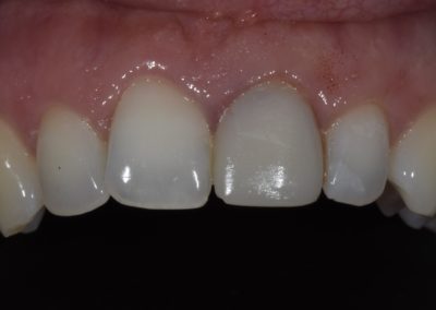 A patient's teeth after a dental crown is placed