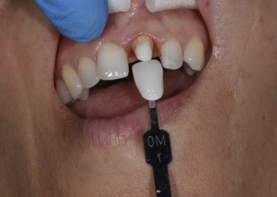 Image of a single central crown dental procedure