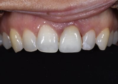 A closeup of a patient's teeth after a single central crown procedure