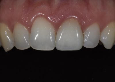 Closeup of a patient's teeth after a single central dental crown procedure