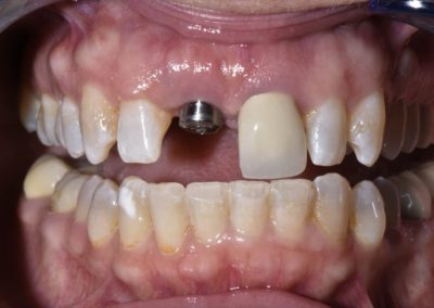 This closeup of a patient's dental implant shows the screw in place.