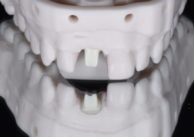 A model of a single central implant procedure