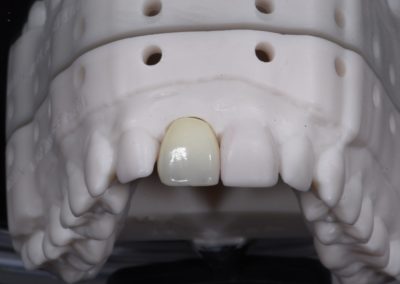 A model of a patient's single central dental implant