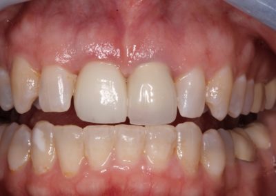 A closeup of a patient's single central dental implant