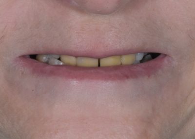 A patient's teeth before full-mouth reconstruction