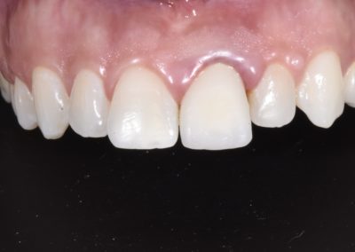 Closeup of a patient's teeth and gums before a smile makeover.