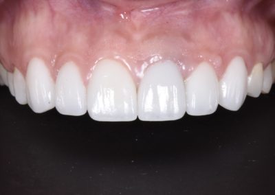 Closeup of teeth after a smile makeover