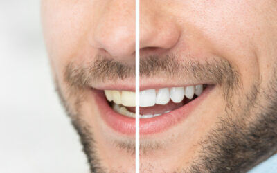 Best Tooth Whitening in the Rochester, Michigan Area: Options You Should Consider