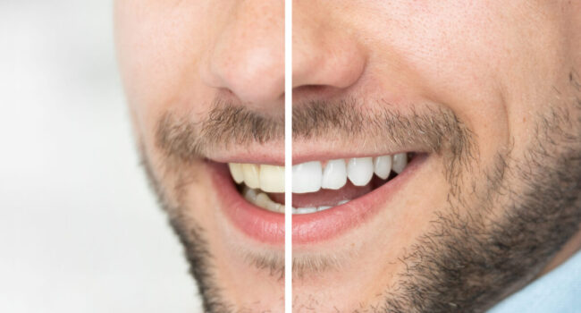 Are you looking for the best tooth whitening in the Rochester, Michigan area? This closeup shows a man's teeth before and after tooth whitening.
