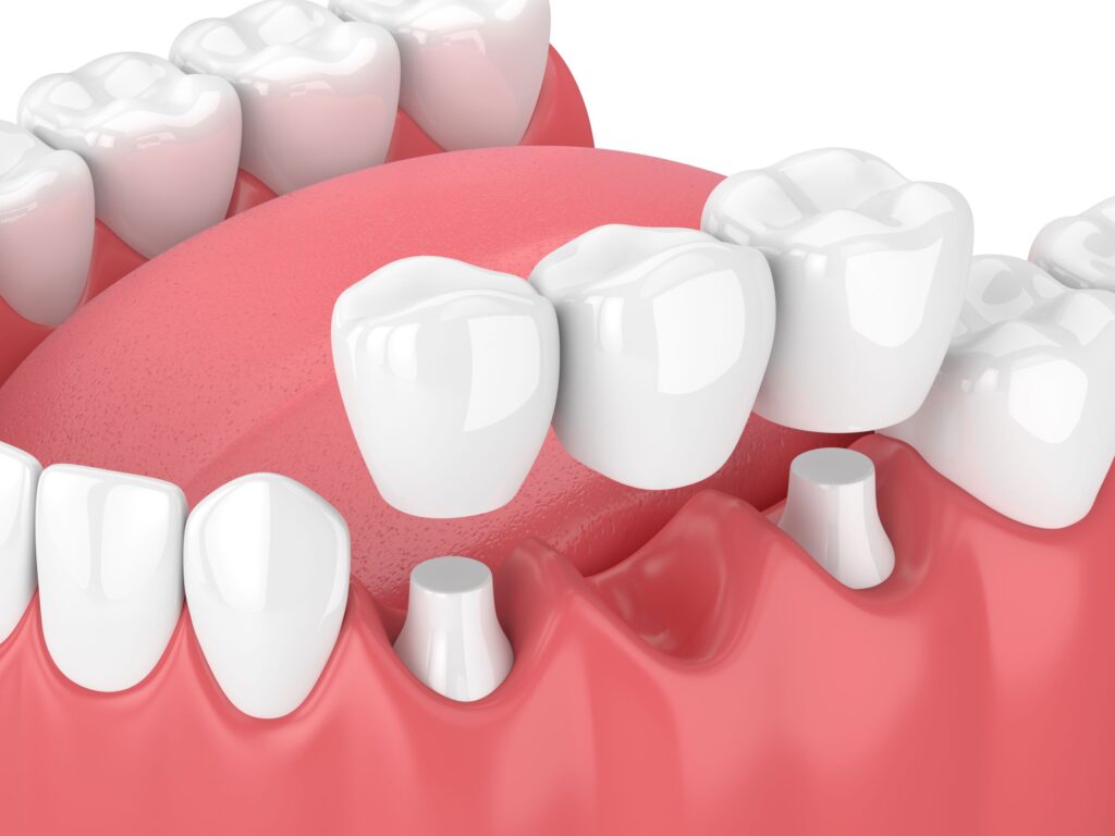 As shown here, a dental bridge consists of a pontic anchored by crowns.